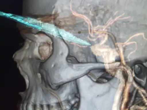 chhota udepur arrow attack on youth