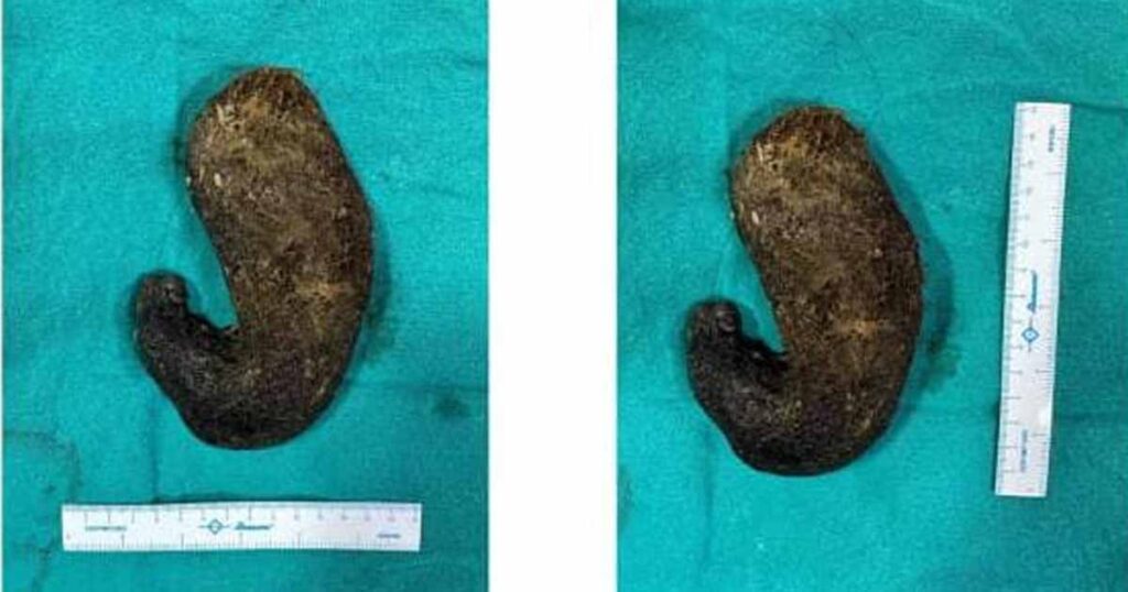 trichobezoar tumor Operation