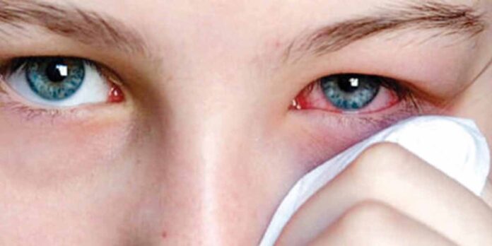 Ahmedabad Conjunctivitis Case