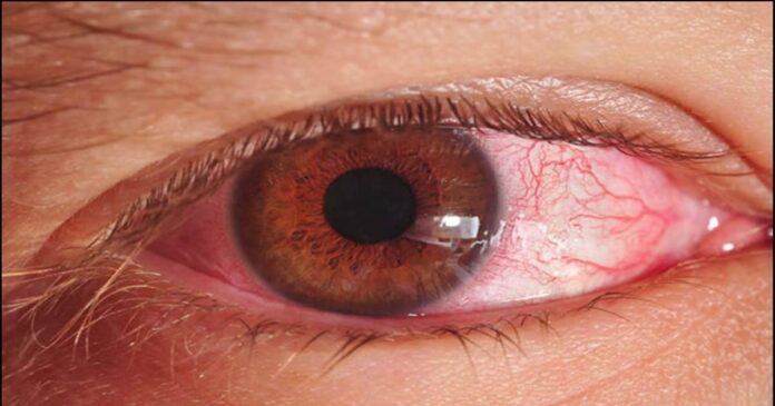 conjunctivitis Cases in Gandhinagar Civil